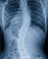 Xray of curved spine